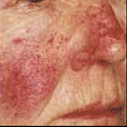 Rosacea – Facial Telangiectasia 1 Patient1 Set1 Before