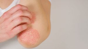 Three Tips for Managing Psoriasis