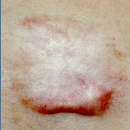 Keloid Scars – 8 Patient1 Set1 After