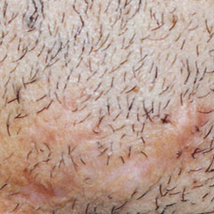 Keloid Scars – 6 Patient1 Set1 After
