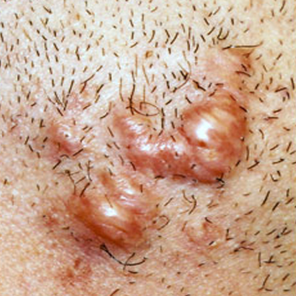Keloid Scars – 6 Patient1 Set1 Before Page