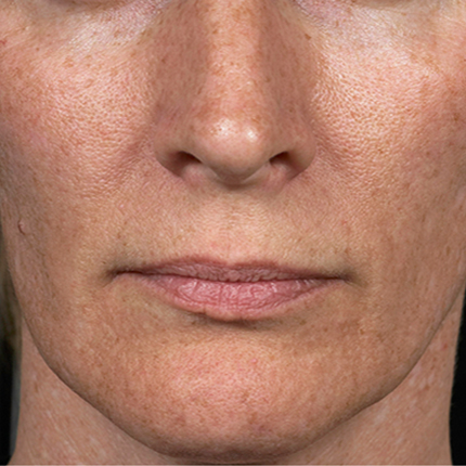 Melasma – 3 Patient1 Set1 After Page