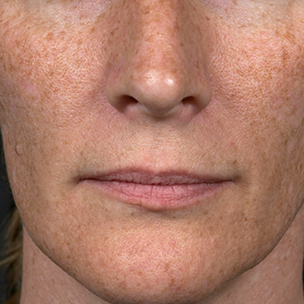 Melasma – 3 Patient1 Set1 Before