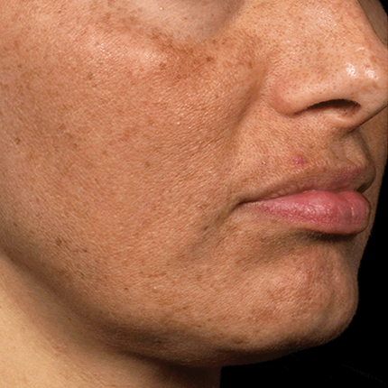 Melasma – 2 Patient1 Set1 After