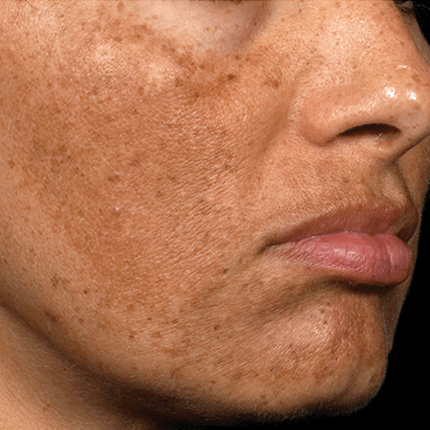 Melasma – 2 Patient1 Set1 Before