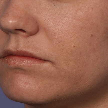 Melasma-1 Patient1 Set1 After Page