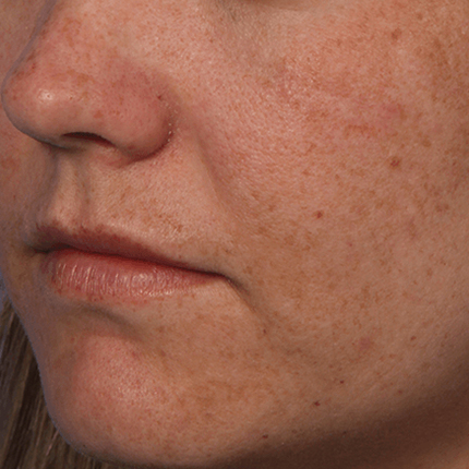 Melasma-1 Patient1 Set1 Before Page