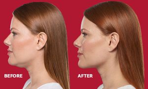 The Ultimate Guide To Kybella