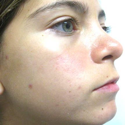 Acne – Acleara Laser – 4 Patient1 Set1 After