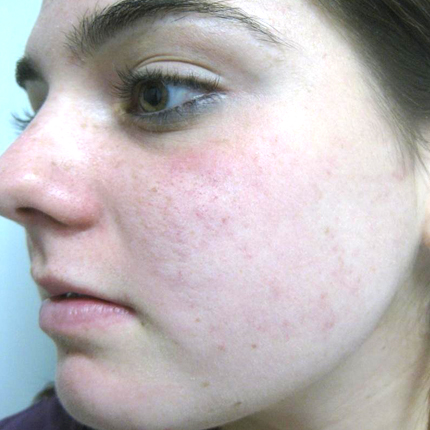 Acne – Acleara Laser 1 Patient1 Set1 After