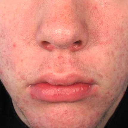 Acne – Acleara Laser -2 Patient1 Set1 After