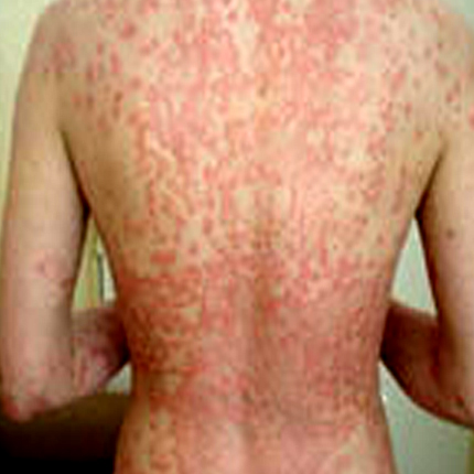 Psoriasis-2 Patient1 Set1 Before