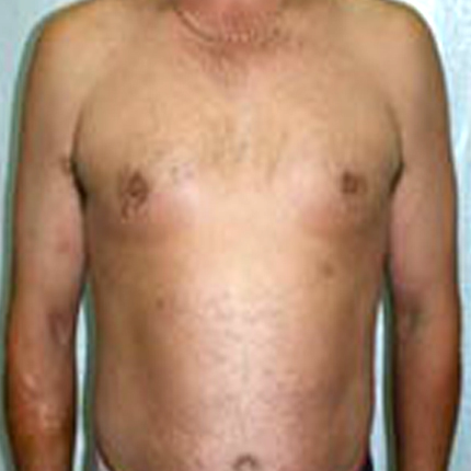 Psoriasis-1 Patient1 Set1 After Page