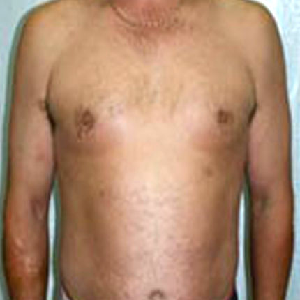 Psoriasis-1 Patient1 Set1 After