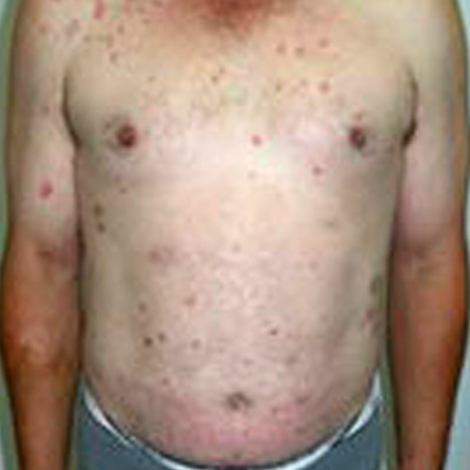 Psoriasis-1 Patient1 Set1 Before Page