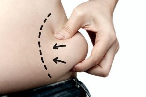 5 Common Myths About Liposuction