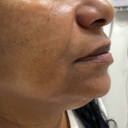 Radiesse: a reduction in the depth of the nasolabial folds Patient1 Set1 After