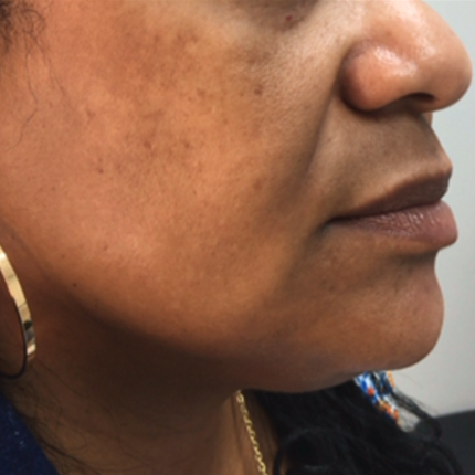 Radiesse: a reduction in the depth of the nasolabial folds Patient1 Set1 Before