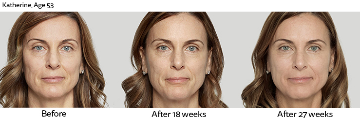 Sculptra patient before and after photo