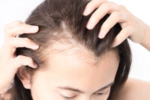 COVID-19 patients are losing their hair. This treatment can help.
