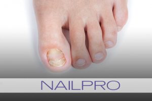 Onychomycosis: Fungus Among Us