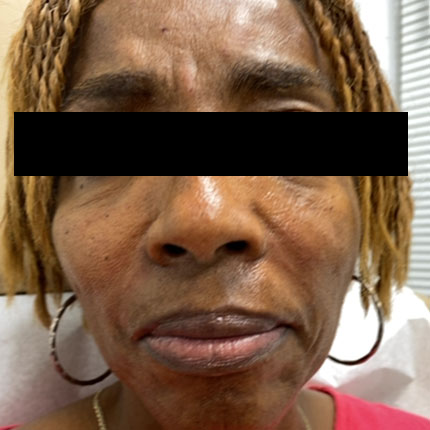 Juvederm – Milgaros Patient1 Set1 After Page