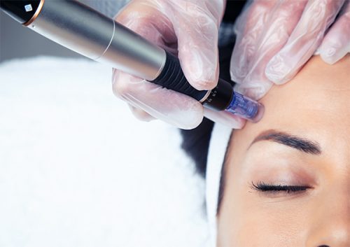 What is Microneedling?