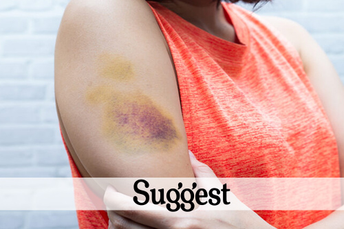 These May Be The Reasons You’re Bruising So Easily