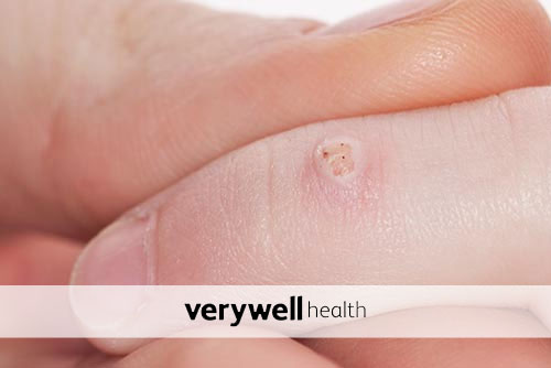 The 6 Best Wart Removers of 2021