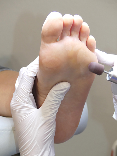 Patient foot at procedure (visit a podiatrist)