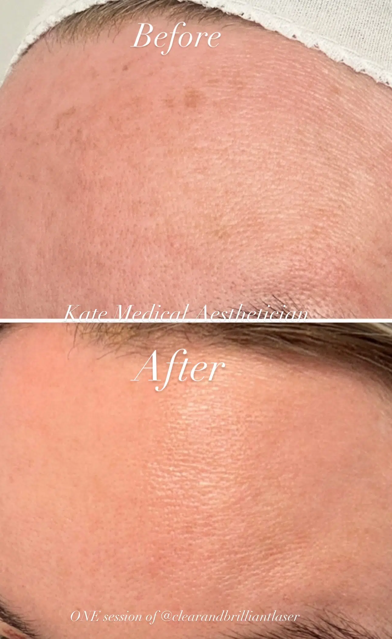 Headshot showing the difference between before and after clear and brilliant laser