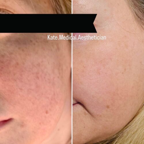 Headshot showing the difference between before and after clear and brilliant laser