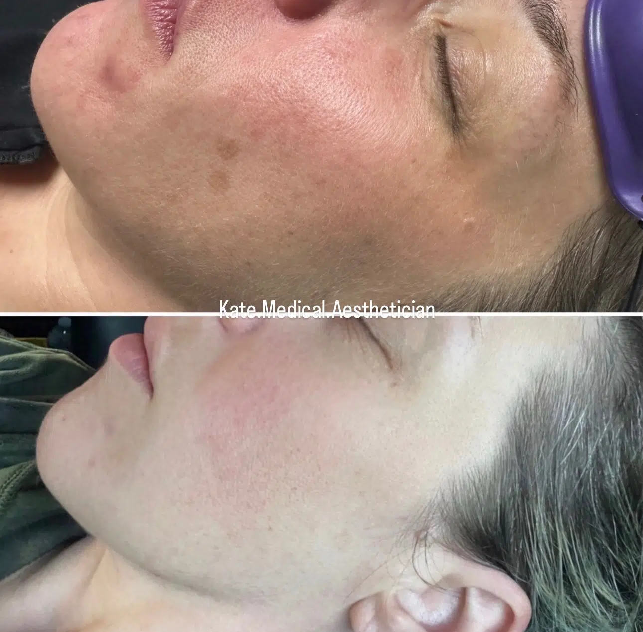 Headshot showing the difference between before and after clear and brilliant laser