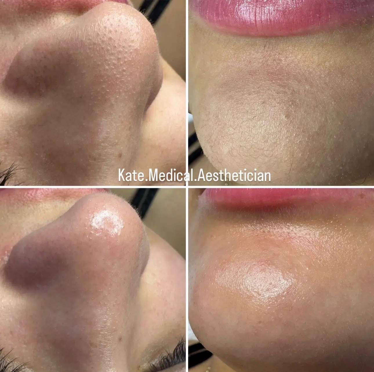 Deep cleansing facial showing the difference between before and after