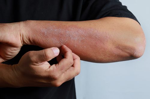 4 Expert Tips For Controlling Atopic Dermatitis