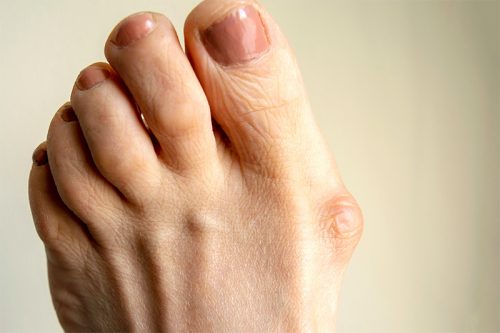 Painful mass or lump on your foot photo