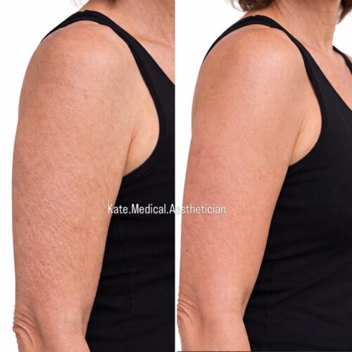 Before & After arm skin tightening