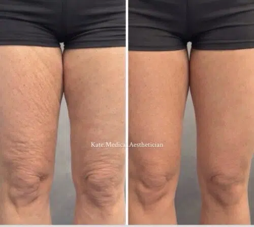 Before & After Leg Tightening