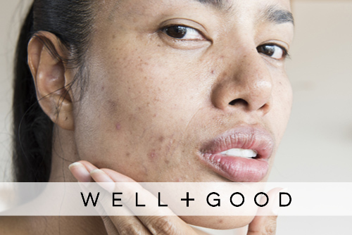 Derms Say These Are the Most Effective Ways To Clear Up Stubborn Hormonal Acne