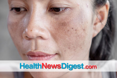 Causes, Treatment and Prevention of Patchy Skin Discoloration