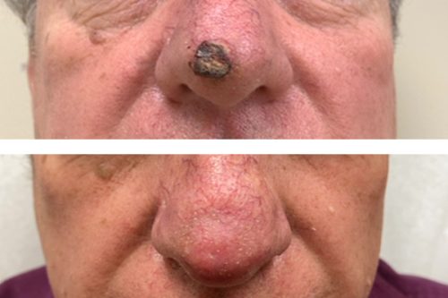 Eyelid Skin Cancer Before and After Photos - Taban MD