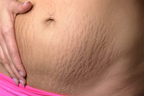 Everything You Need To Know About Stretch Marks