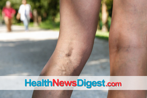 What Can Be Done Today About Varicose Veins?