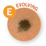 Melanoma evolution small photo