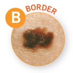 Melanoma border small photo