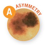 Melanoma asymmetry small photo