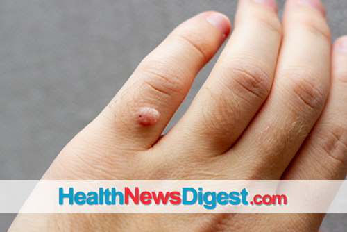 What To Do About Warts