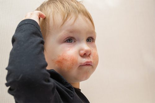 How To Provide Relief to Children With Eczema