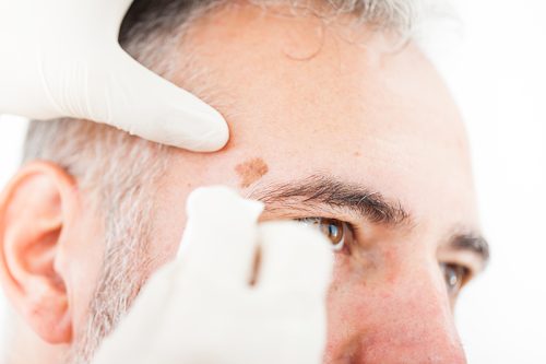How to Treat Sun Spots