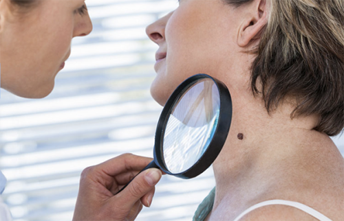 What types of skin cancer are there?